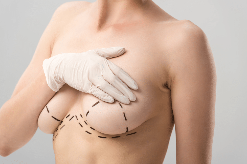 Breast Lift