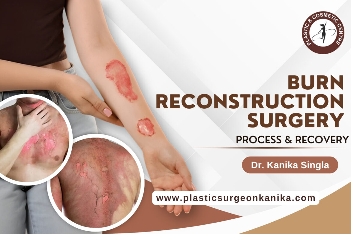 Burn Reconstruction Surgery
