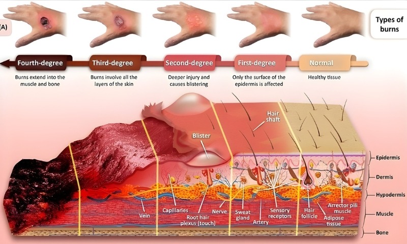 Burn Reconstruction Surgery
