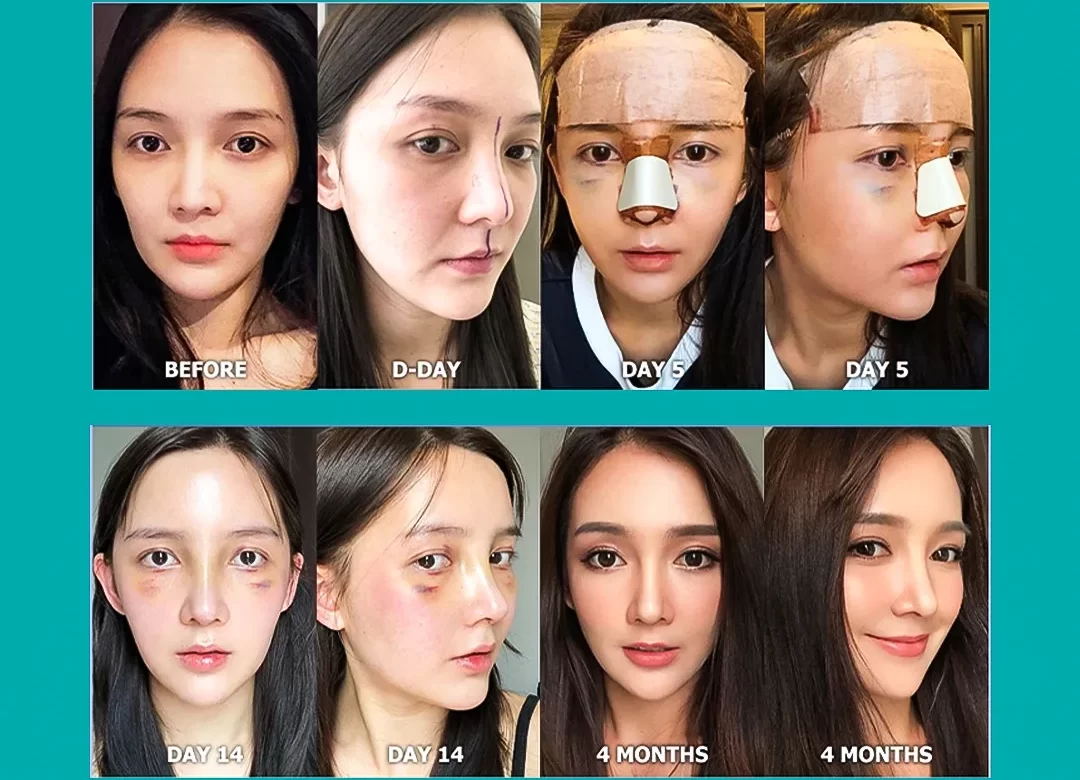 Closed Rhinoplasty Recovery Timeline: Swelling, Healing and Results