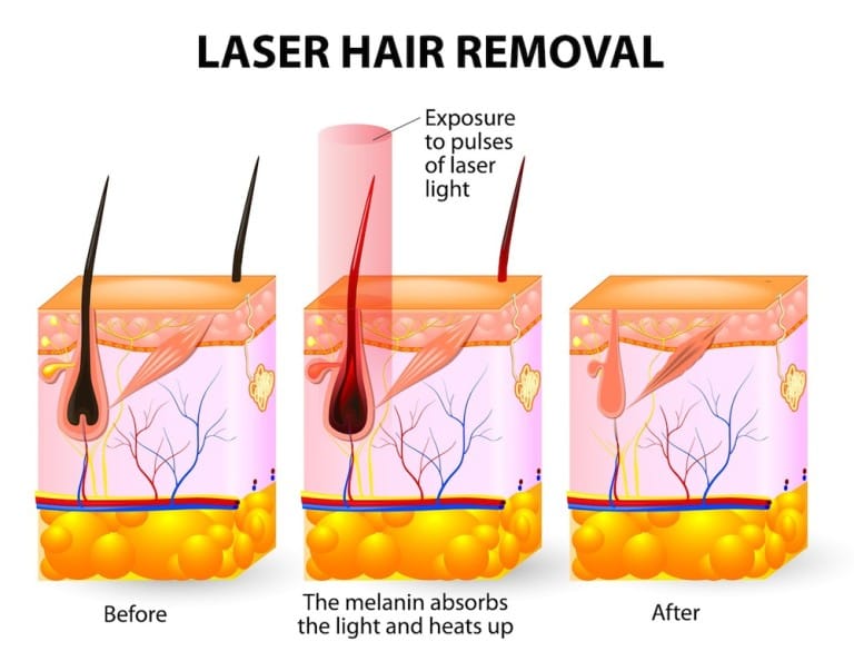 What to Expect During Your First Laser Hair Removal Session